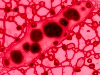 Ostra_bialaczka_szpikowa