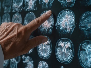 Choroba_alzheimera