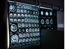 Neuroonkologia